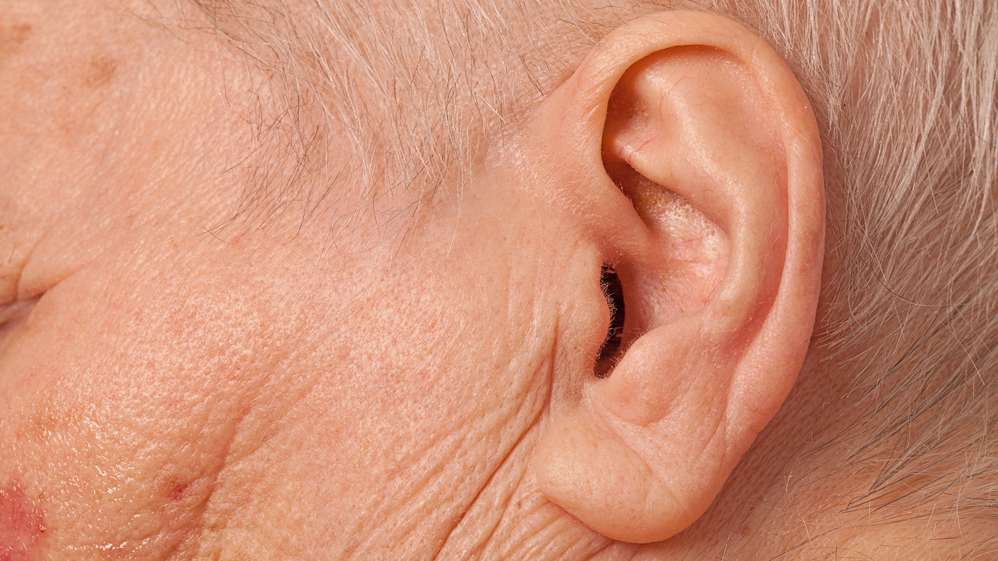Gene therapy breakthrough for treatment of hearing loss