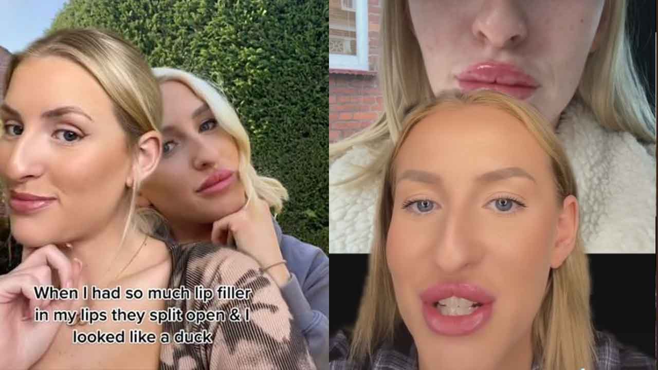 "It’s not worth it": Woman shares botched lip filler treatment