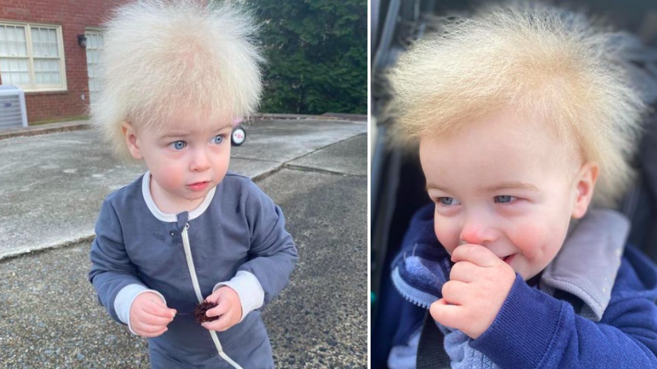 Rare uncombable hair syndrome gives little Finn fuzzy locks  The West  Australian