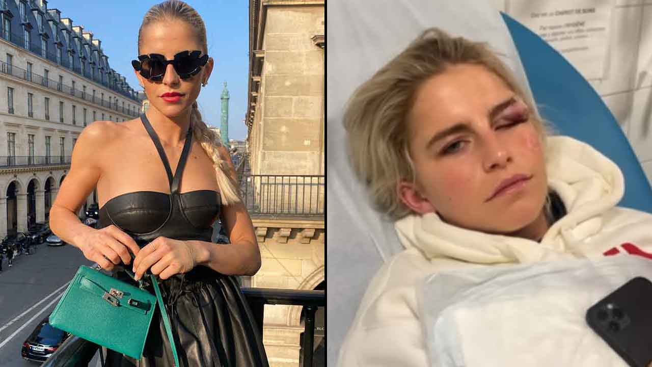 Model shares grisly injury from Paris Fashion Week
