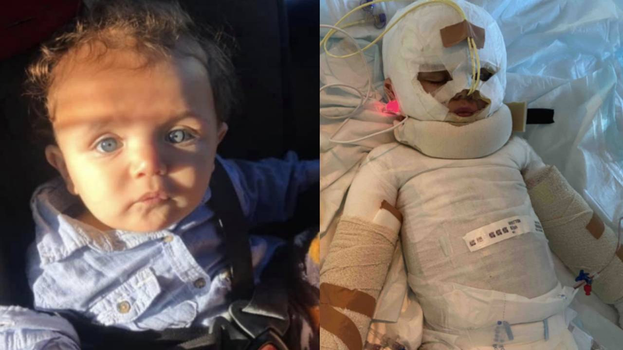 Heartwarming update for toddler who suffered catastrophic burns