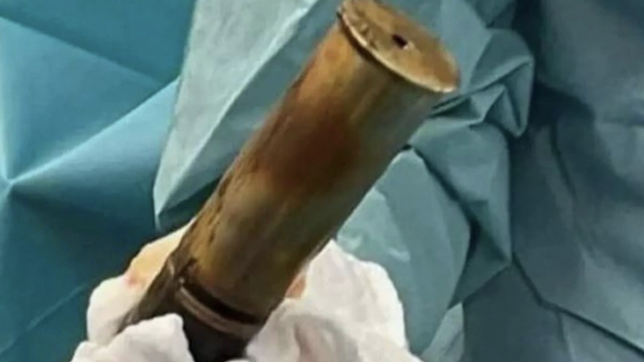 Bum scare! Hospital evacuated over man with WWI explosive up his backside
