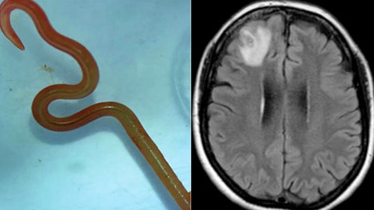 Finding a live brain worm is rare. 4 ways to protect yourself from more common parasites