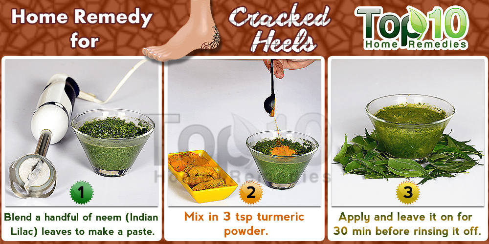 foot crack natural remedies