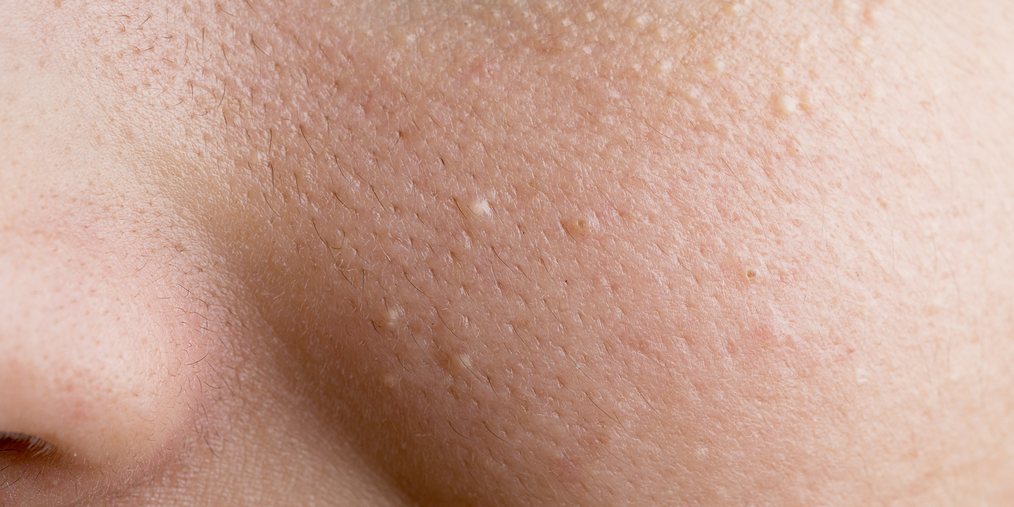 Why we get little white dots under our skin