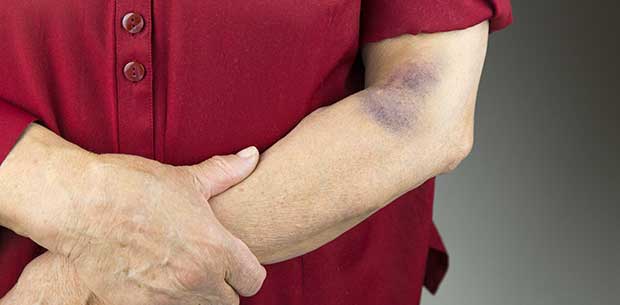 Why some people bruise easier than others