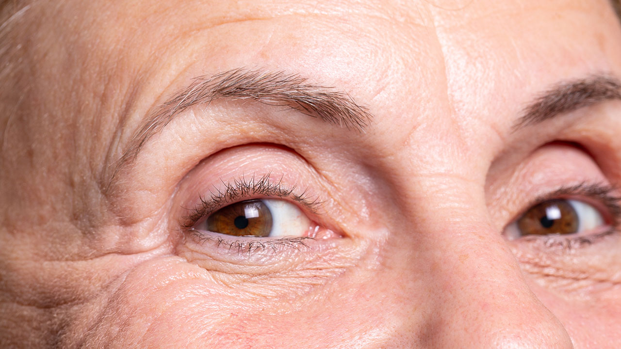 Could you be at risk? Here’s what your wrinkles may be telling you