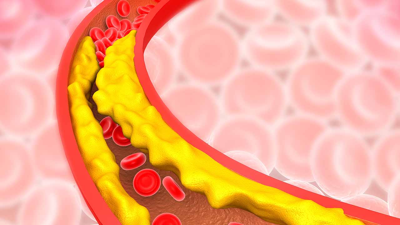 7 silent signs you may have clogged arteries