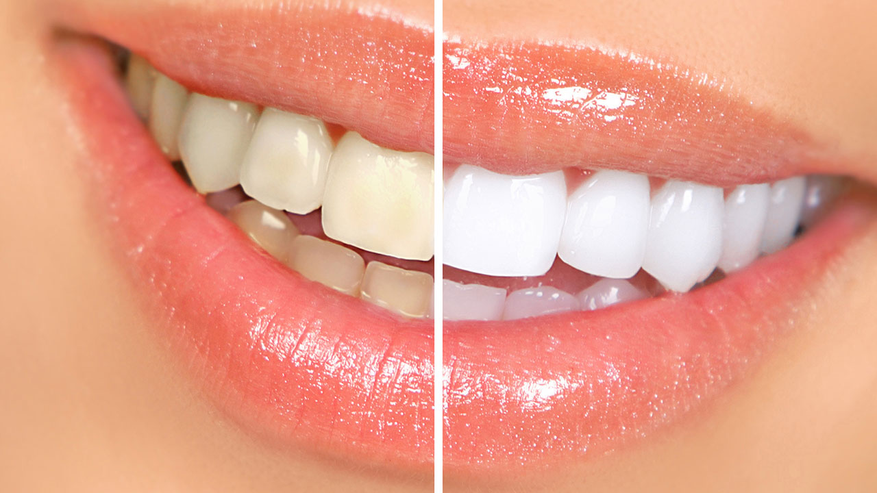 Ask the experts: Is teeth whitening bad for your teeth?