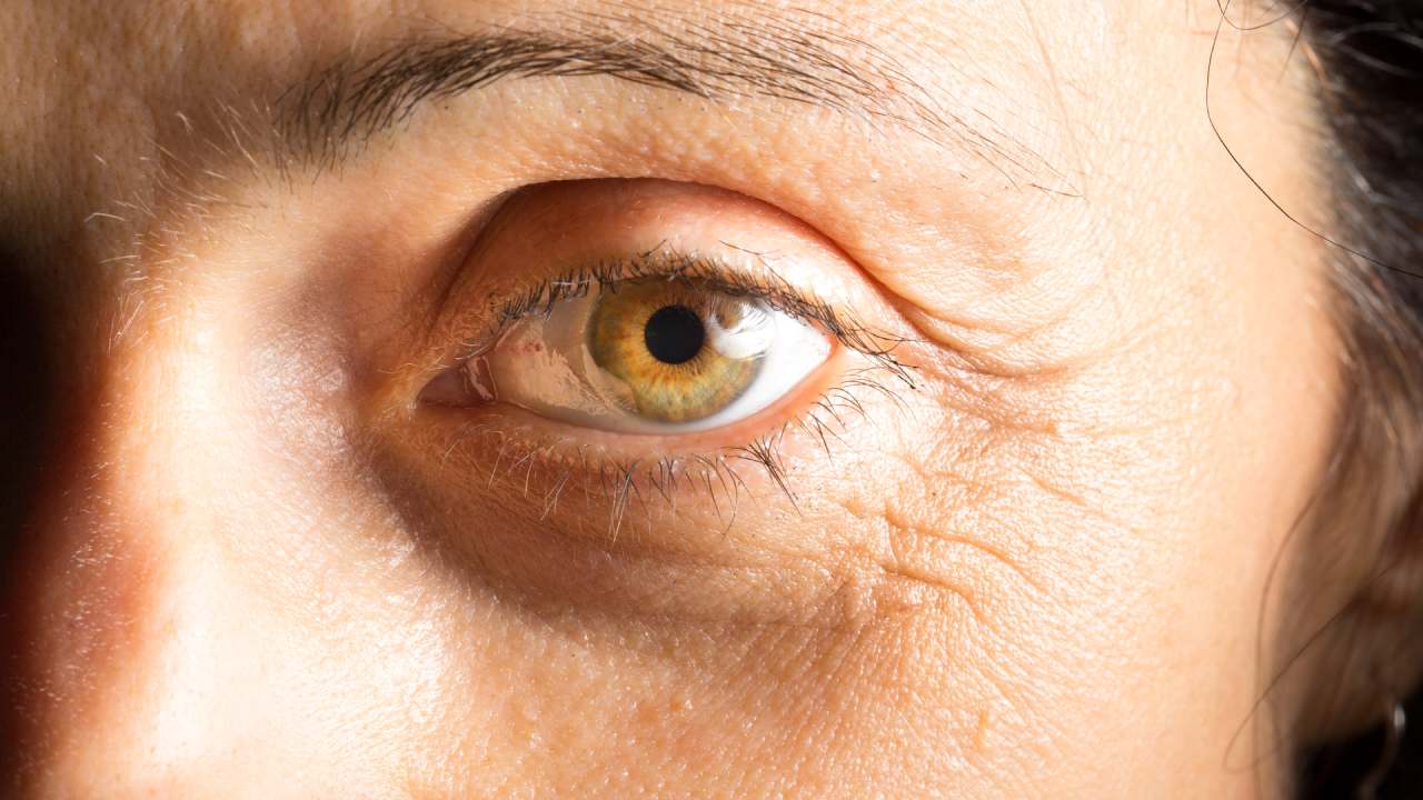 Why do we get dark circles under our eyes?