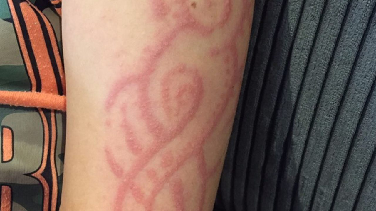 Scarred for life: henna tattoo turns young boy's Bali holiday into nightmare