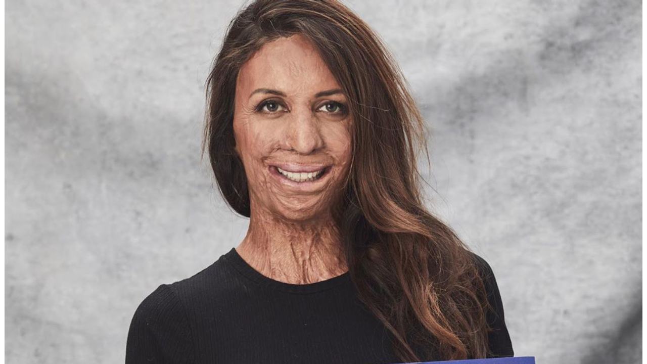 Turia Pitt likened to “can of baked beans”