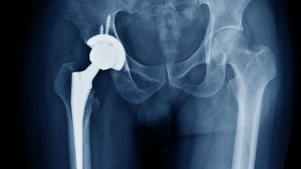 Why women are more likely to have dodgy hip implants or other medical devices