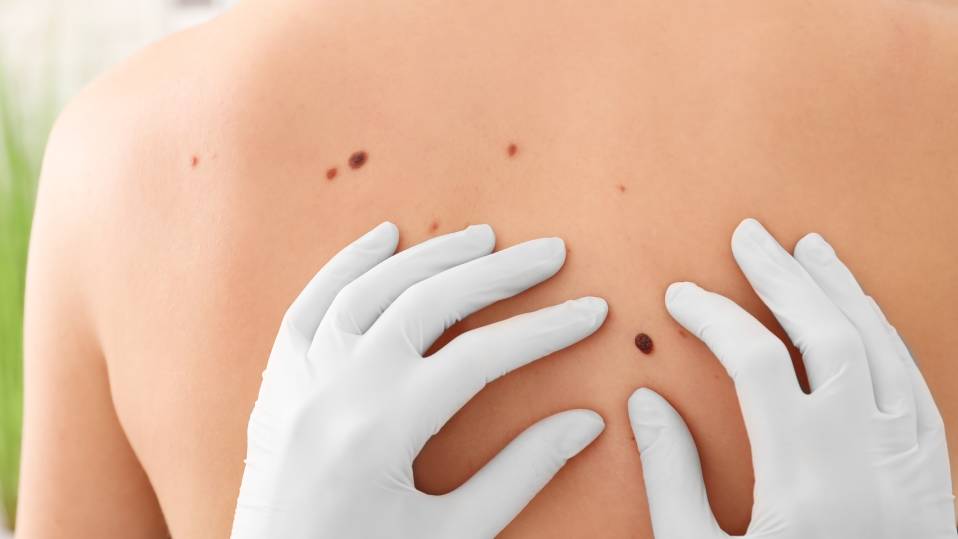 5 places you can surprisingly get skin cancer that aren’t on your skin