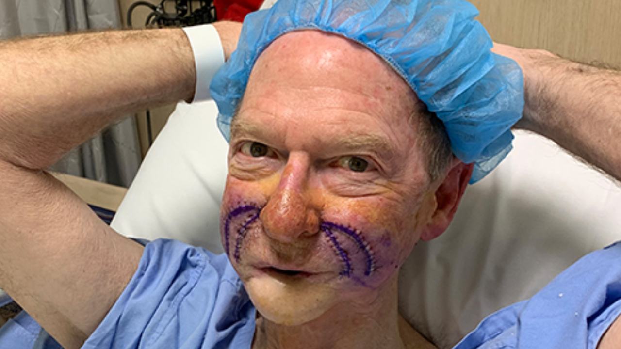 Hey Hey It’s Saturday star John Blackman undergoes more facial surgery