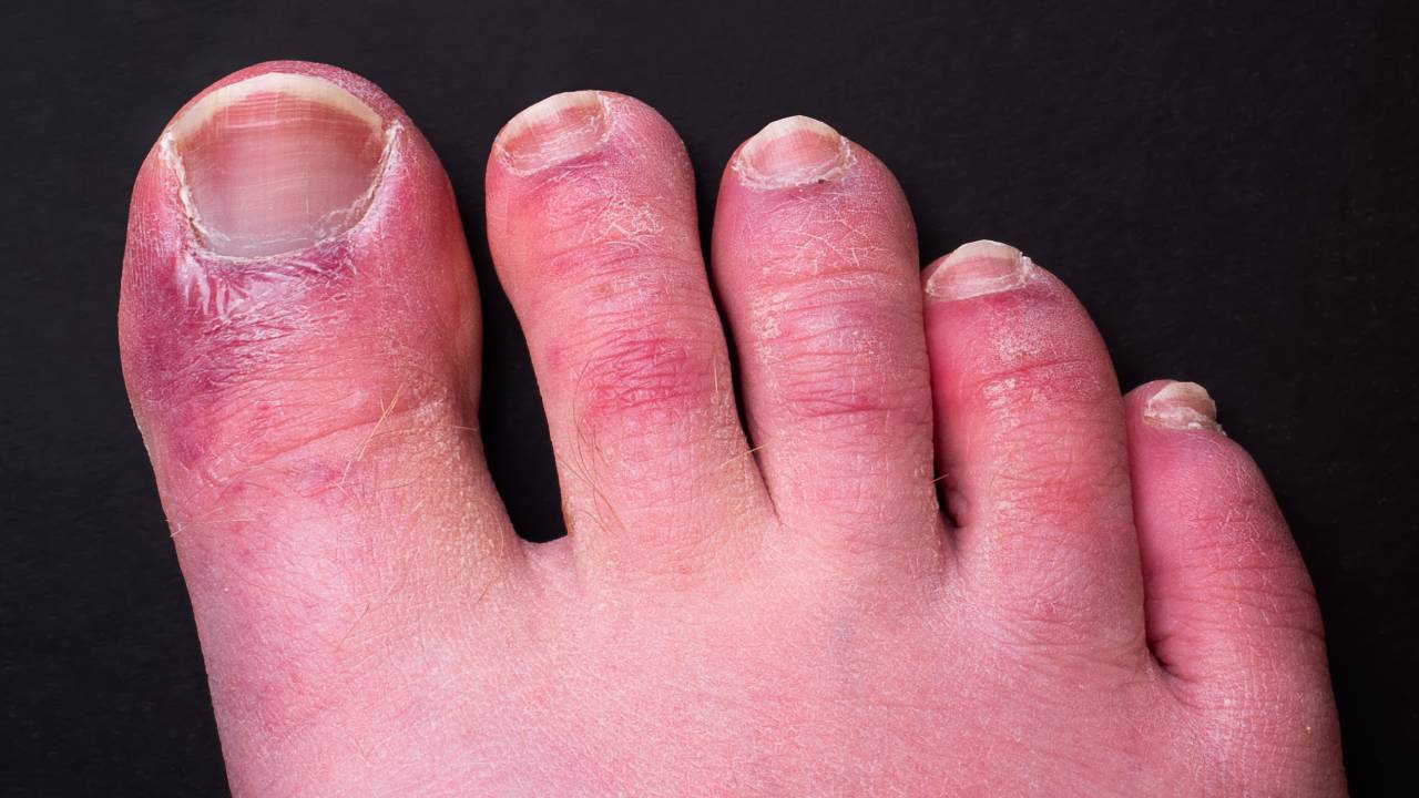 Check your feet! 'COVID toes' are a new and more rampant sign of coronavirus