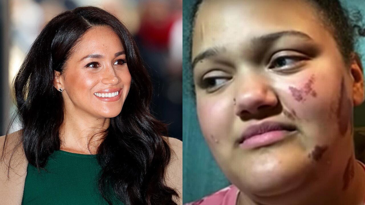 Duchess Meghan reaches out after 18-year-old woman was set on fire in alleged hate crime