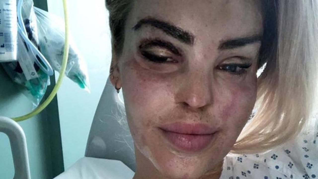 “Ugly and repulsive”: Acid attack survivor slams troll after undergoing 400th operation