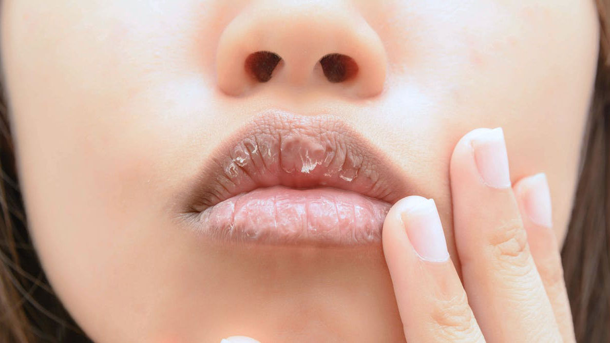 What Causes Dry Lips And How Can You Treat Them Does Lip Balm