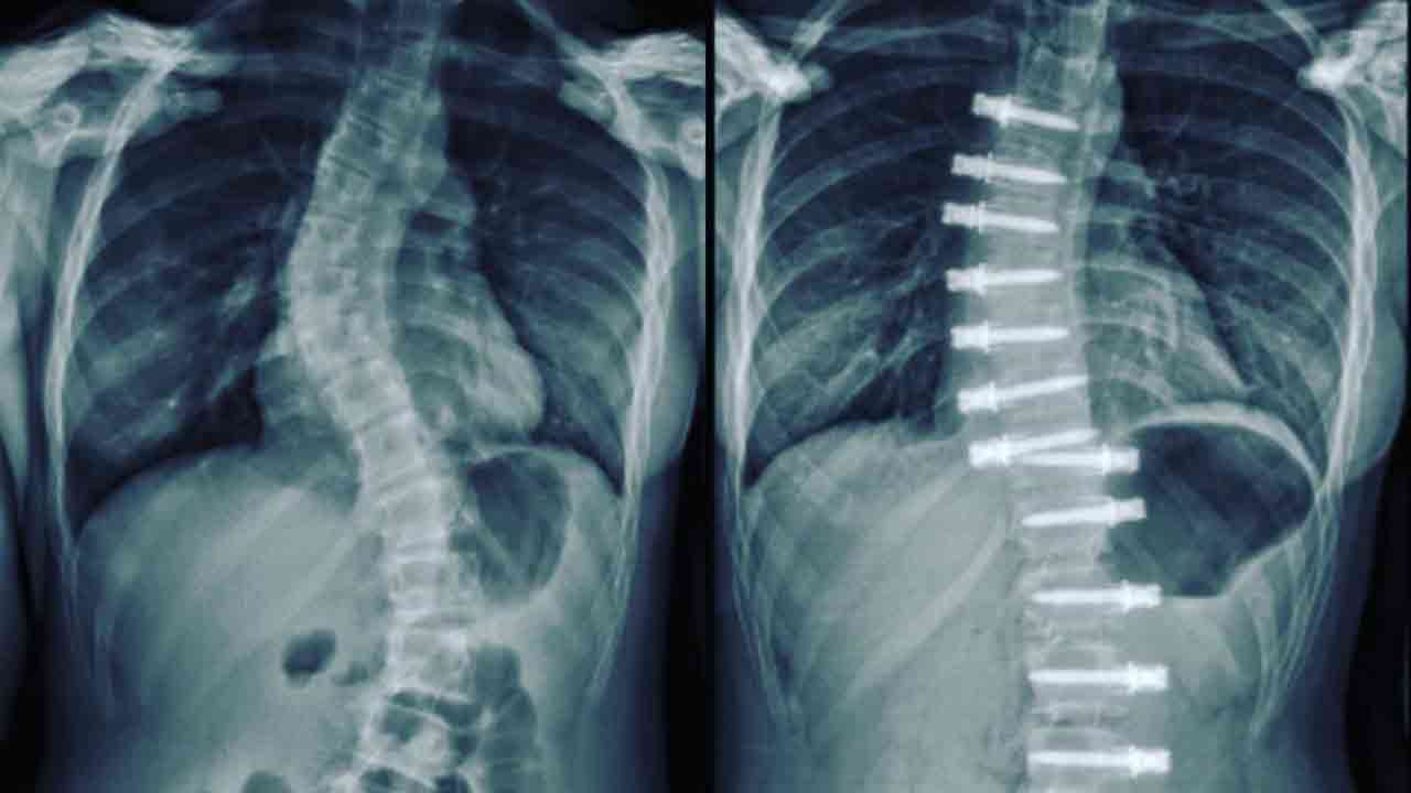 4 facts to know about scoliosis