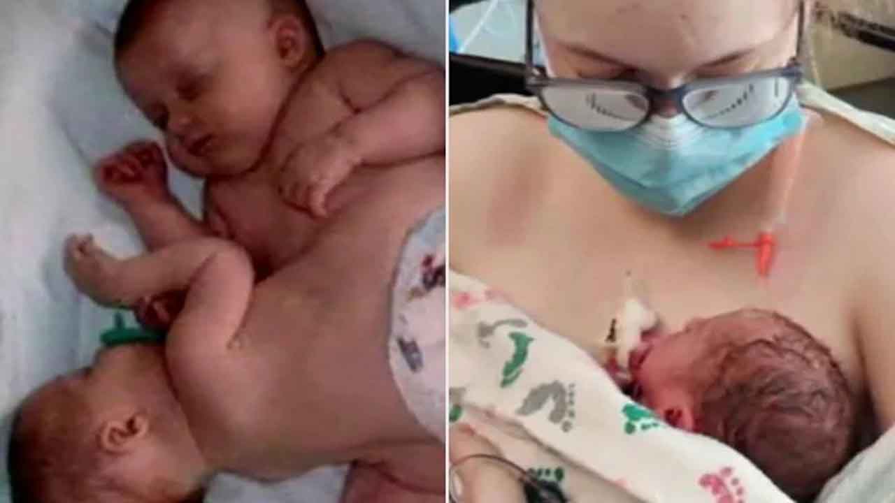 “Medical triumph”: Conjoined twin survivor gives birth