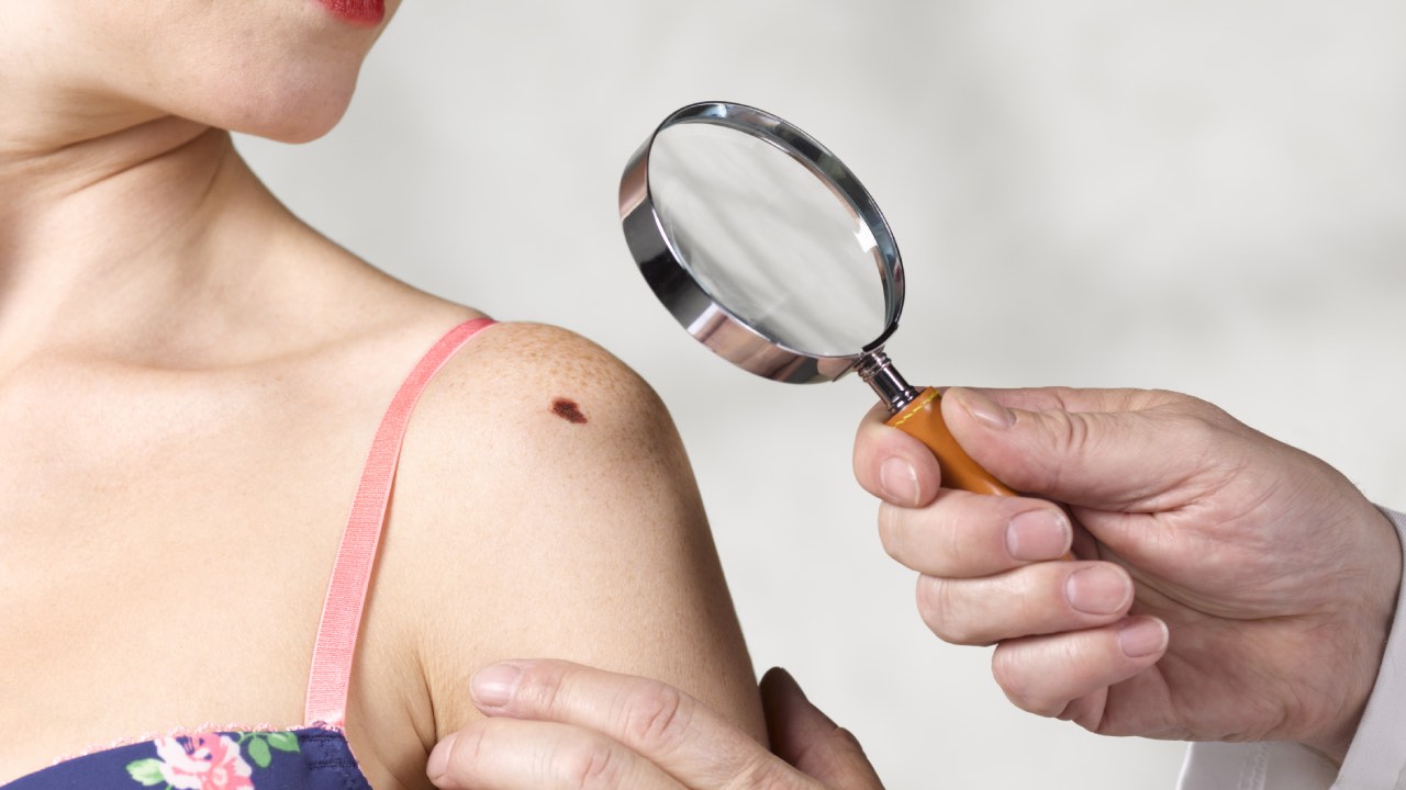 A smart way to monitor melanoma