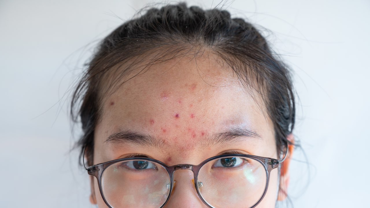What really causes pimples and acne?