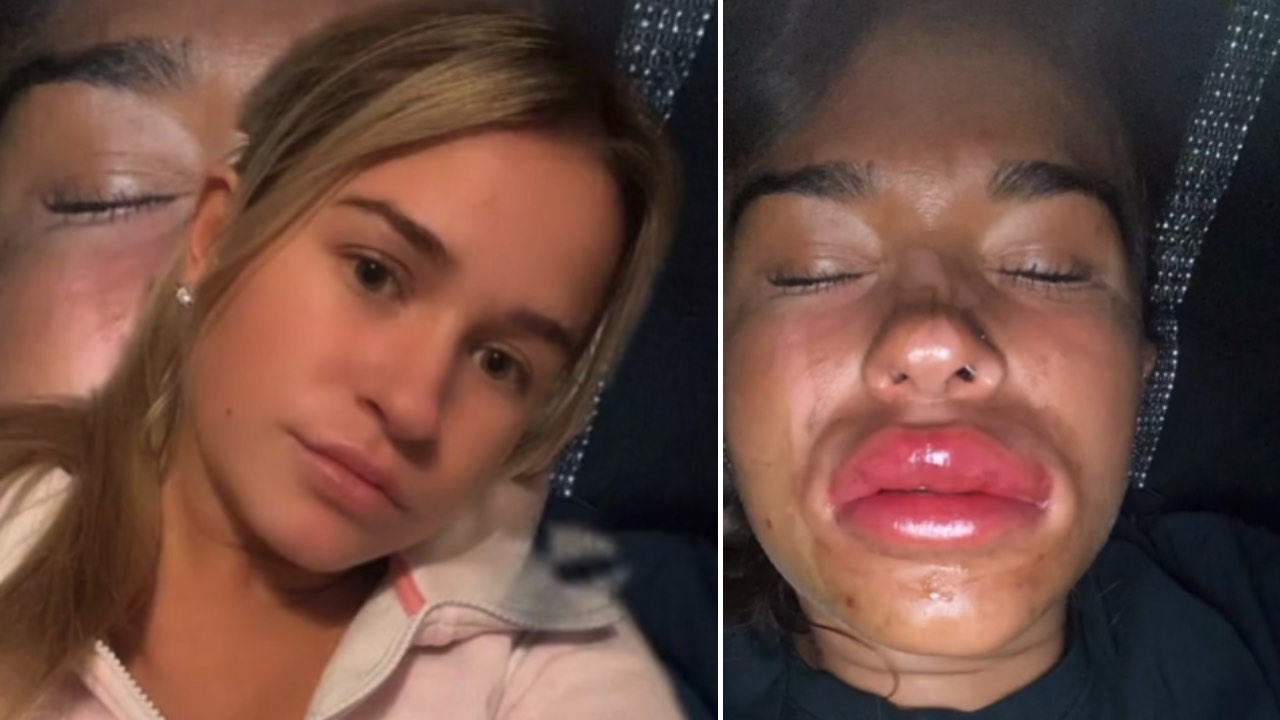 Woman has shocking reaction after lip filler